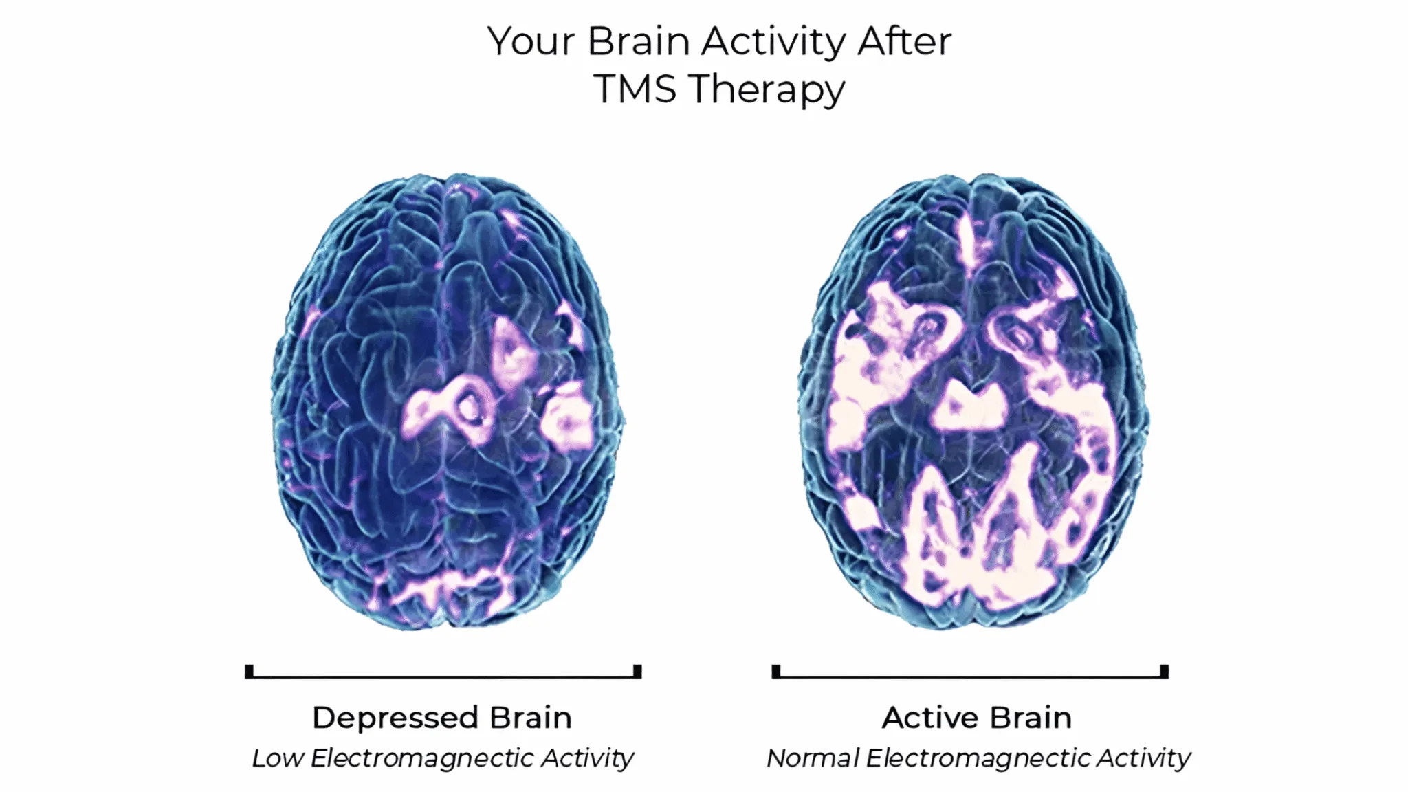 Before and After PET Scans showing Deep TMS Neural Impact